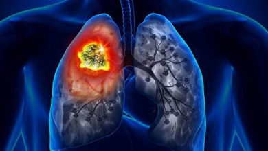 نتایج امیدوارکننده قرص سرطان ریه در آزمایشهای انسانی