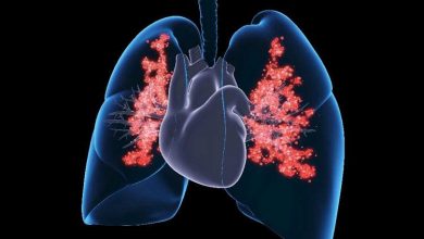 رژیم غذای پرچرب و پرکربوهیدرات ممکن است خطر سرطان ریه را افزایش دهد