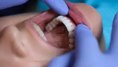 هشدار پزشکی: بیماری لثه، عامل پنهان سکته مغزی