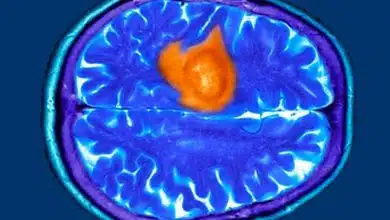 هفت نشانه پنهان تومور مغزی که ممکن است آنها را عادی بپندارید