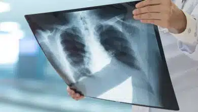 ارتباط رژیم غذایی و سرطان ریه: نقش حیاتی قند در رشد تومور