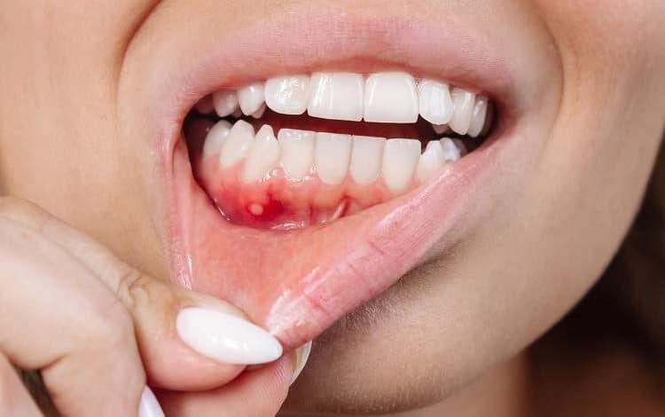 وقتی پوسیدگی دندان به مغز حمله میکند