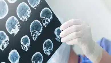 بازماندگان سرطان: سپر طبیعی در برابر آلزایمر!