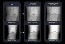 تشخیص زودهنگام آرتروز با هوش مصنوعی؛ تصویری از زانوی یک سال بعد